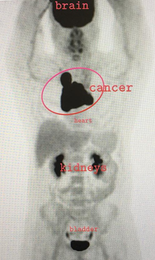 Cory's initial PET scan of the Lymphoma