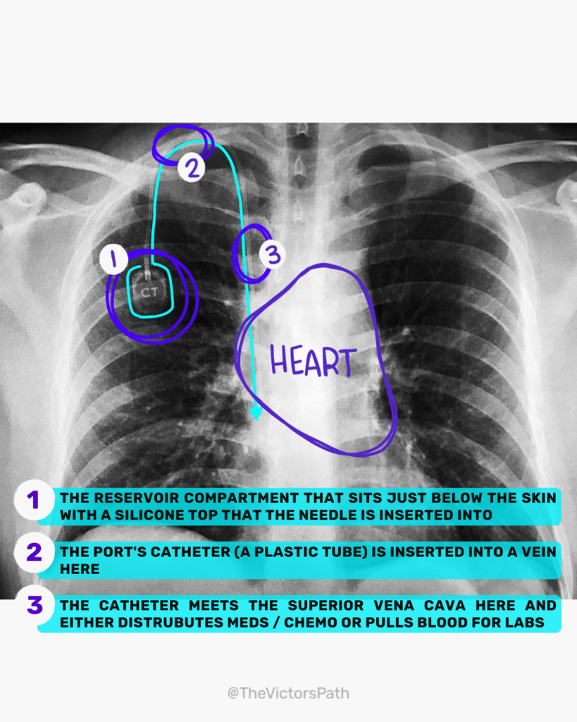 chest port x-ray